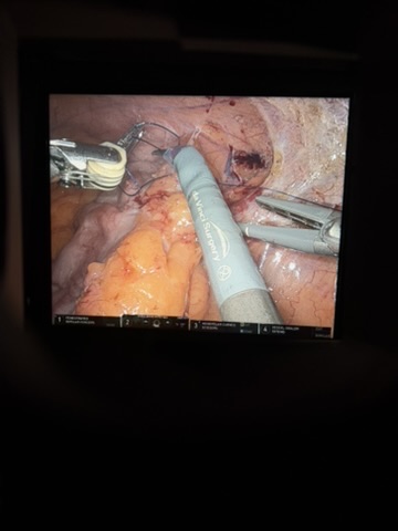 da Vinci colorectal surgical oncology view